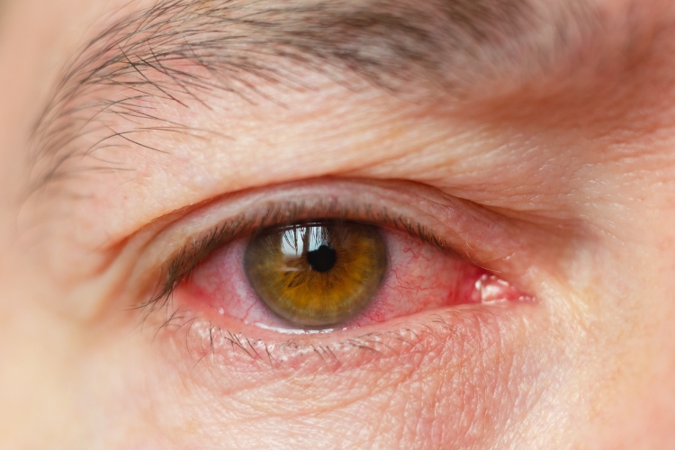 Glaucoma Diagnosis And Surgery